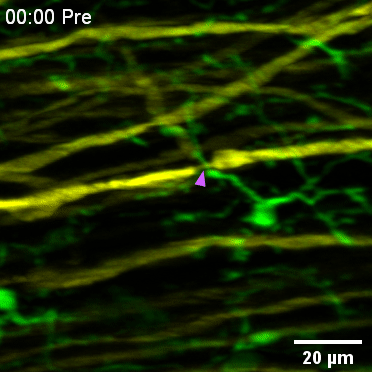 免疫细胞迅速从稍远位置转移至受损位置，并包围朗飞结（以紫色标示）以防止轴突进一步退化