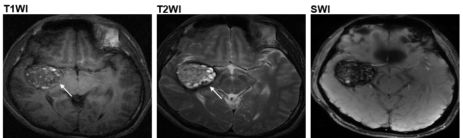 CCM二型患者於腦血管中長有爆谷形狀腫瘤 (箭嘴示)  