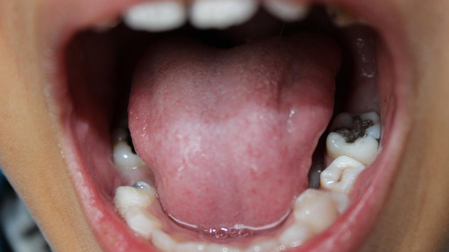 HKUST Researchers Unlock the Micro-Molecular Physiochemical Mechanism of Dental Plaque Formation