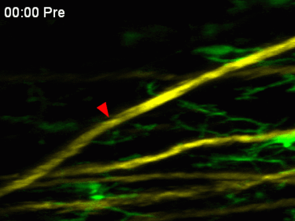研究發現當軸突（以黃色標示）被飛秒脈衝雷射（以紅色標示）切斷後，免疫細胞（以綠色標示）迅速反應並轉移至受損位置